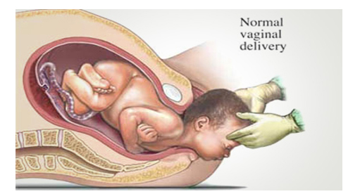 child vagina Vaginal Birth Vs. C-Section